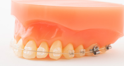 ファイン矯正歯科の矯正方法
